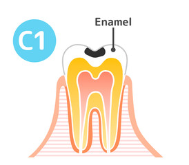 Caries and Progression and Treatment: Dental Illustration