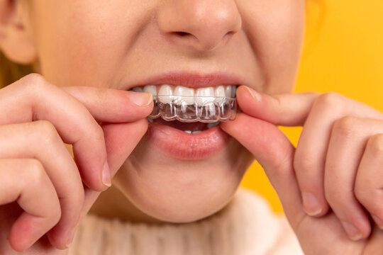 A beautiful girl puts a dental retainer on her teeth, she stands on a yellow background. Orthodontist. Dental tray. Retainer. Advertising. Place for an inscription.