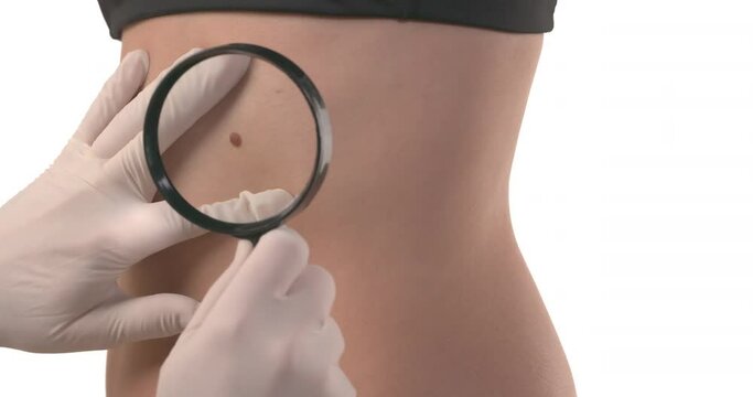 Close up of skin mole checking on Caucasian woman's abdominal region. Dermatologist's hands in gloves examining birthmark with magnifying glass. Isolated on white background.