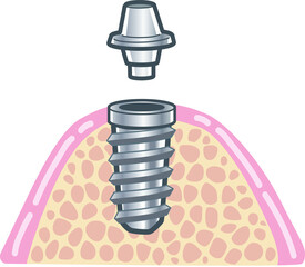 アバットメントイラスト