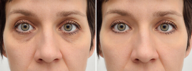Female eye bags before and after cosmetic treatment or plastic procedure, blepharoplasty. Close-up.