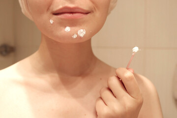 Treat problem skin. Ointment for acne treatment. Close-up of the lower part of the face of a young...