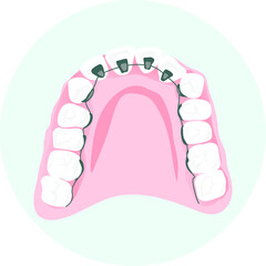 vector icon of lower jaw with dental braces. Braces advertising concept.