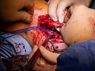  vascular surgeon prepares a leg artery for bypass surgery - obrazy, fototapety, plakaty
