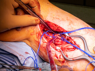  vascular surgeon prepares a leg artery for bypass surgery