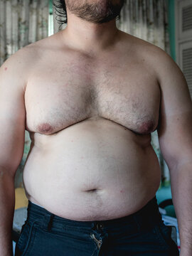 An out of shape torso, large belly, man boobs, some chest hair and slight body acne. Overweight and slightly obese. Light complexion.