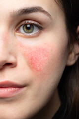 A case of early rosacea on a young woman's face.
