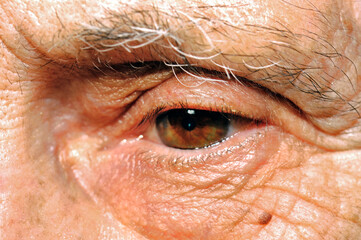 Skin damage and sight loss due to aging.  Close-up of a very old Caucasian woman’s eye.