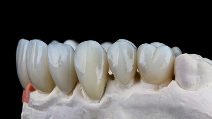 ceramic dental veneers and crowns on a black background side view of the model