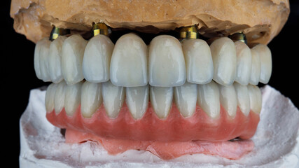 ceramic dentures for the upper and lower jaw, on plaster models in the bite