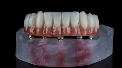 temporary lower jaw prosthesis with pink gum on a resin model, shot against a black background