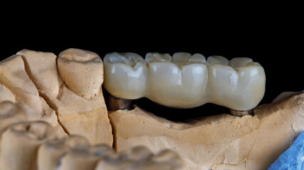 Fototapeta na wymiar dental bridge for three teeth made of zircon on the model