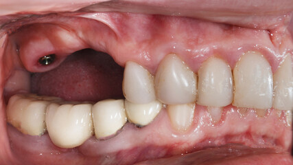 jaw after implantation before prosthetics of a ceramic or zircon bridge on the chewing teeth