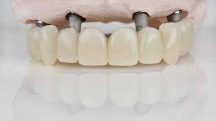 dental prosthesis of temporary upper jaw on a bar with a model on a white background