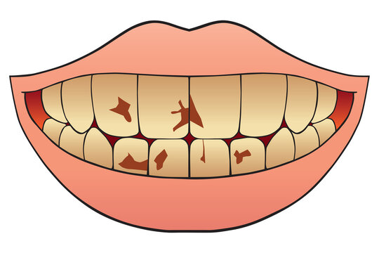 Nicotine Stained Teeth