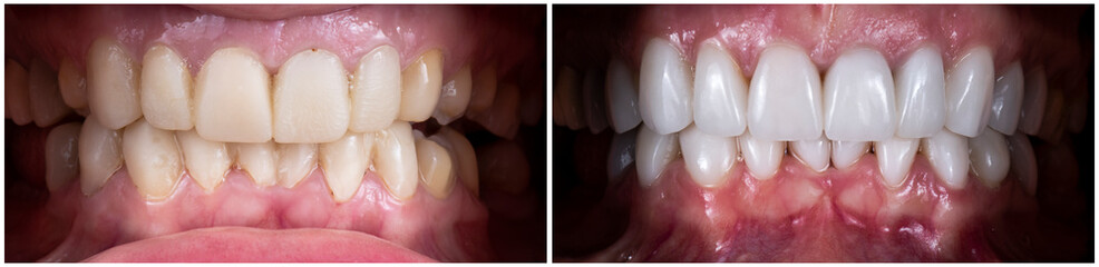 before and after picture after fixing 20 unit emax press ceramic veneers