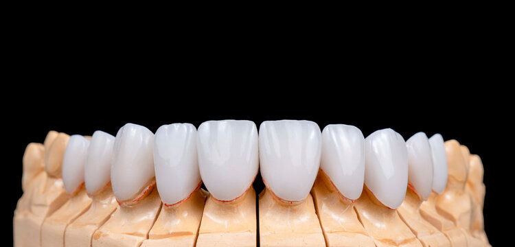 20 unit emax press ceramic veneers