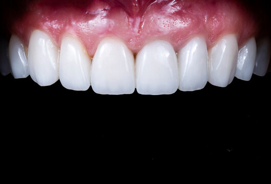 20 unit emax press ceramic veneers