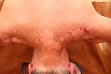Fototapeta premium sunburn skin on the back of a man
