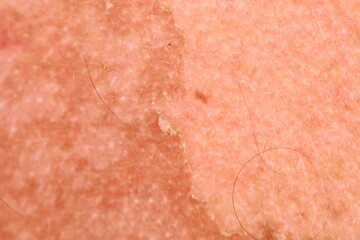Fototapeta premium sunburn skin on the back of a man