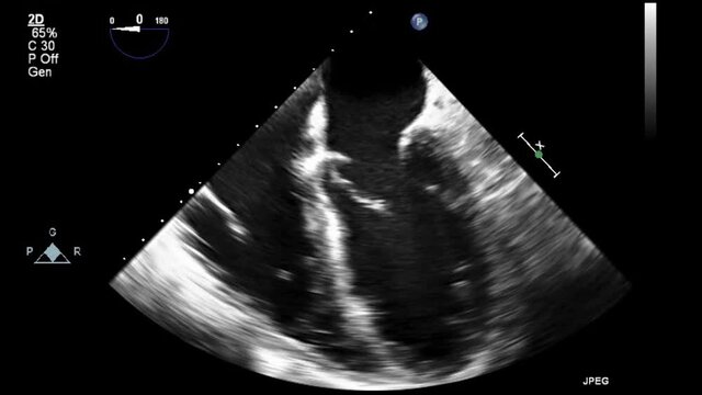 Transesophageal ultrasound video in gray-scale mode.