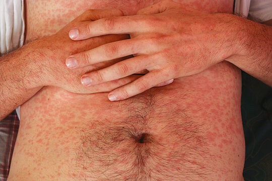 Measles or rubeola rash on Caucasian man's skin