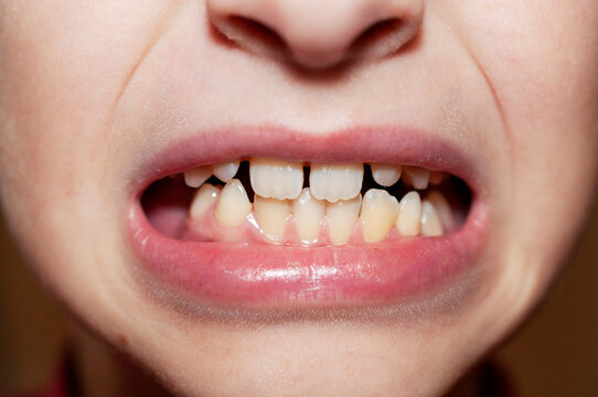 Close-up of children's molar and milk teeth, oral care, dentist