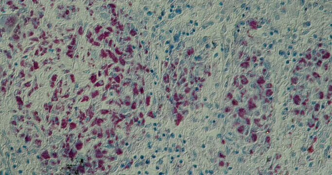 AIDS Mycobacteria tissue under the microscope 200x