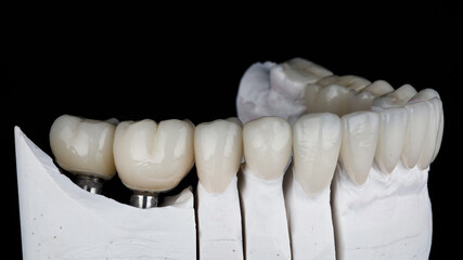 dental model with ceramic crowns and white veneers on a black background