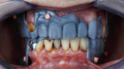 wax up digital future dental prosthesis and bridges, after implantation