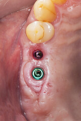 Fototapeta premium gingival cavity with implants for installing dental crowns