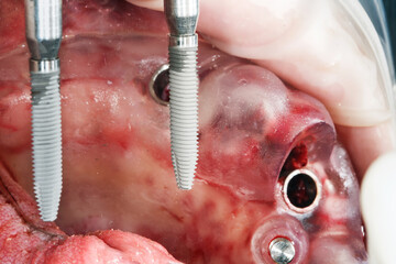 large dental implant before insertion through a surgical template