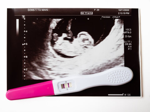Positive pregnancy test and first prenatal ultrasound scan
