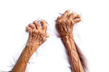 The hands of an old woman with rheumatoid arthritis. Diseases caused by degeneration of the joints...