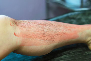 Fototapeta premium Hot, pink wax is applied to a woman's hairy leg. Hair removal on the legs in a beauty salon. Waxing. The concept of beauty, body care. Selective focus.