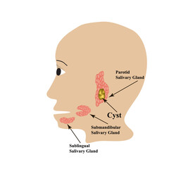 Parotid salivary gland. Submandibular salivary gland. Sublingual salivary gland. cyst. Vector illustration on isolated background