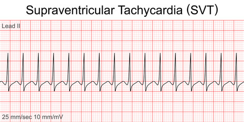 Electrocardiogram show Supraventricular tachycardia (SVT) pattern. Cardiac fibrillation. Heart beat.ECG. EKG.Vital sign.Medical healthcare symbol.