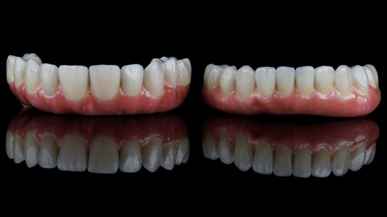 two high-quality dental prostheses made of ceramic and titanium on black glass with creative reflection