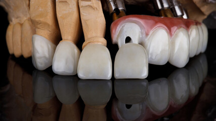 beautiful composition of dental veneers and dentures of the upper jaw on black glass with reflection © Dental Pro Content