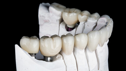 beautiful dental crowns and ceramic veneers on the model, filmed on a black background