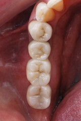 installed dental bridge of chewing teeth made of zircon in the gum cavity