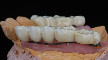 zirconium bridges for the chewing part of the jaw on the model
