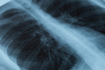 X-ray of the lungs. Close-up. Diagnostics of chronic and fatal diseases.