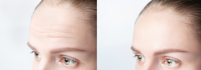 Forehead wrinkles before and after mefotherapy injection, treatment, surgery. Womans face close up