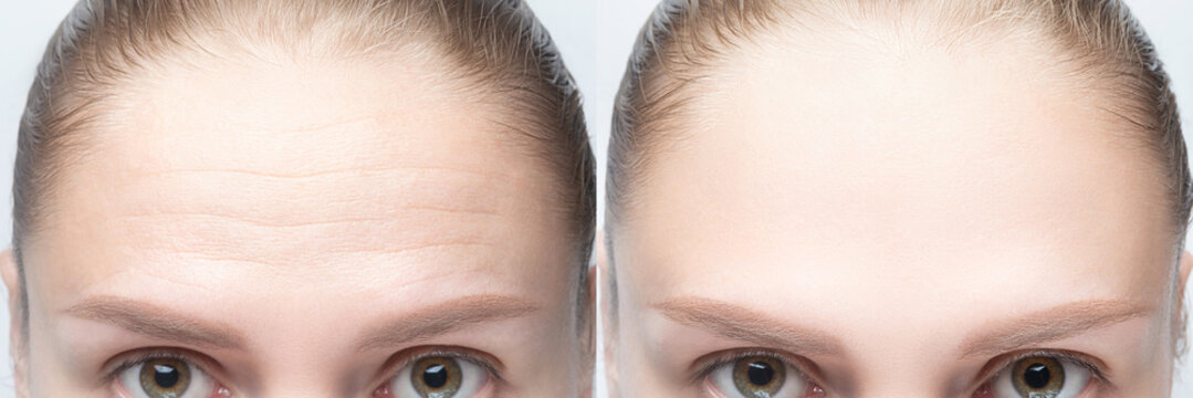 Forehead wrinkles before and after injection, treatment, surgery. Womans face close up