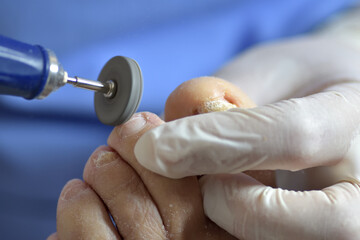 chiropody lathe removing impurities from the toes
