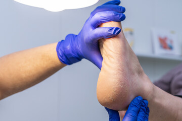 Feet with dry skin, cracked heels, podiatrist examining patient - obrazy, fototapety, plakaty