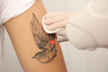 Young man undergoing laser tattoo removal procedure in salon, closeup