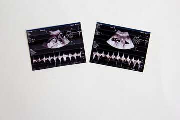 Twins ultrasonography embryos of 18 weeks top view with white background