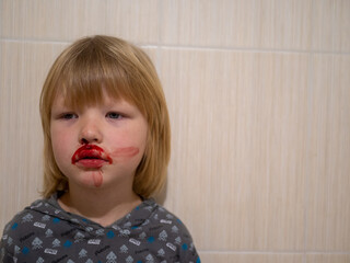little fair-haired boy is smeared with blood. baby has weak vessels in nose bursting with pressure...